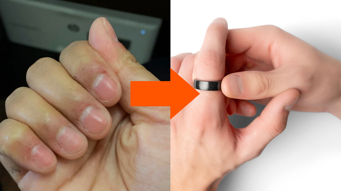 5 Best Strategies and Tools to Stop Nail Biting and Skin Picking for Good